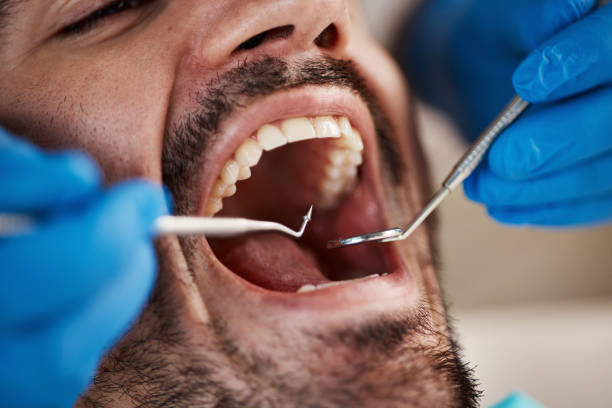 Best Emergency Root Canal Therapy in Wliamsvle, IL